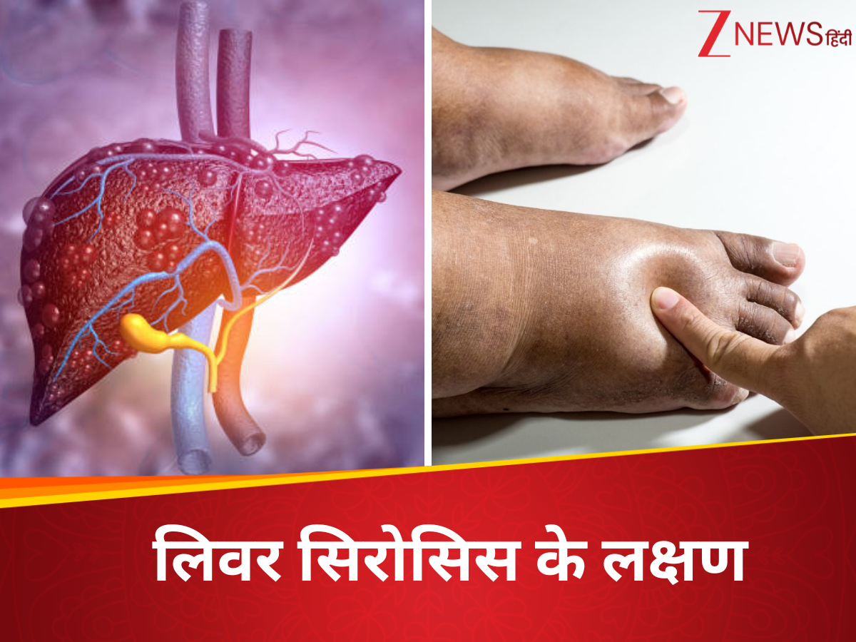 fatty liver starts becoming cirrhosis water starts filling in these ...