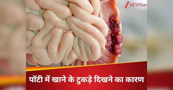 Food particles in stool do not ignore more than 2 times may symptom of ...