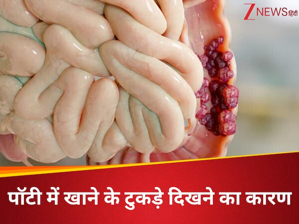Food particles in stool do not ignore more than 2 times may symptom of ...
