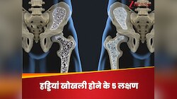 हड्डियों को खोखला कर चूरा बना देती है ये बीमारी, 5 लक्षण दिखें तो जाएं डॉ. के पास