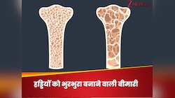 हड्डियों को अंदर से कमजोर कर भुरभुरा बना देती है ये बीमारी, खत्म हो जाती है ताकत
