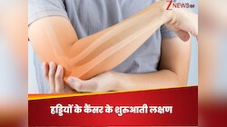 हड्डियों का कैंसर करता है चुपके से वार, इन 5 शुरुआती लक्षणों को जरूर पहचानें