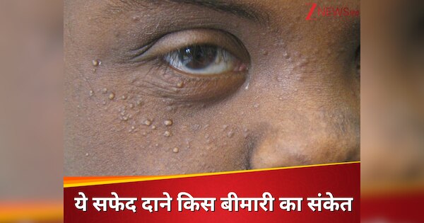 White spots around eyes indicates these serious disease in your body ...
