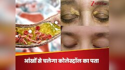 आंखों में झलक जाएंगे हाई कोलेस्ट्रॉल के 5 लक्षण, देखते ही कराएं टेस्ट