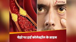चेहरे में दिख जाएंगे हाई कोलेस्ट्रॉल के लक्षण, बस पहचानने होंगे ये 5 सबसे कॉमन इशारे