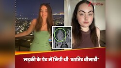 लड़की का सूज गया था चेहरा, कॉफी को कर रही थी ब्लेम, लेकिन पेट में छिपी थी बीमारी