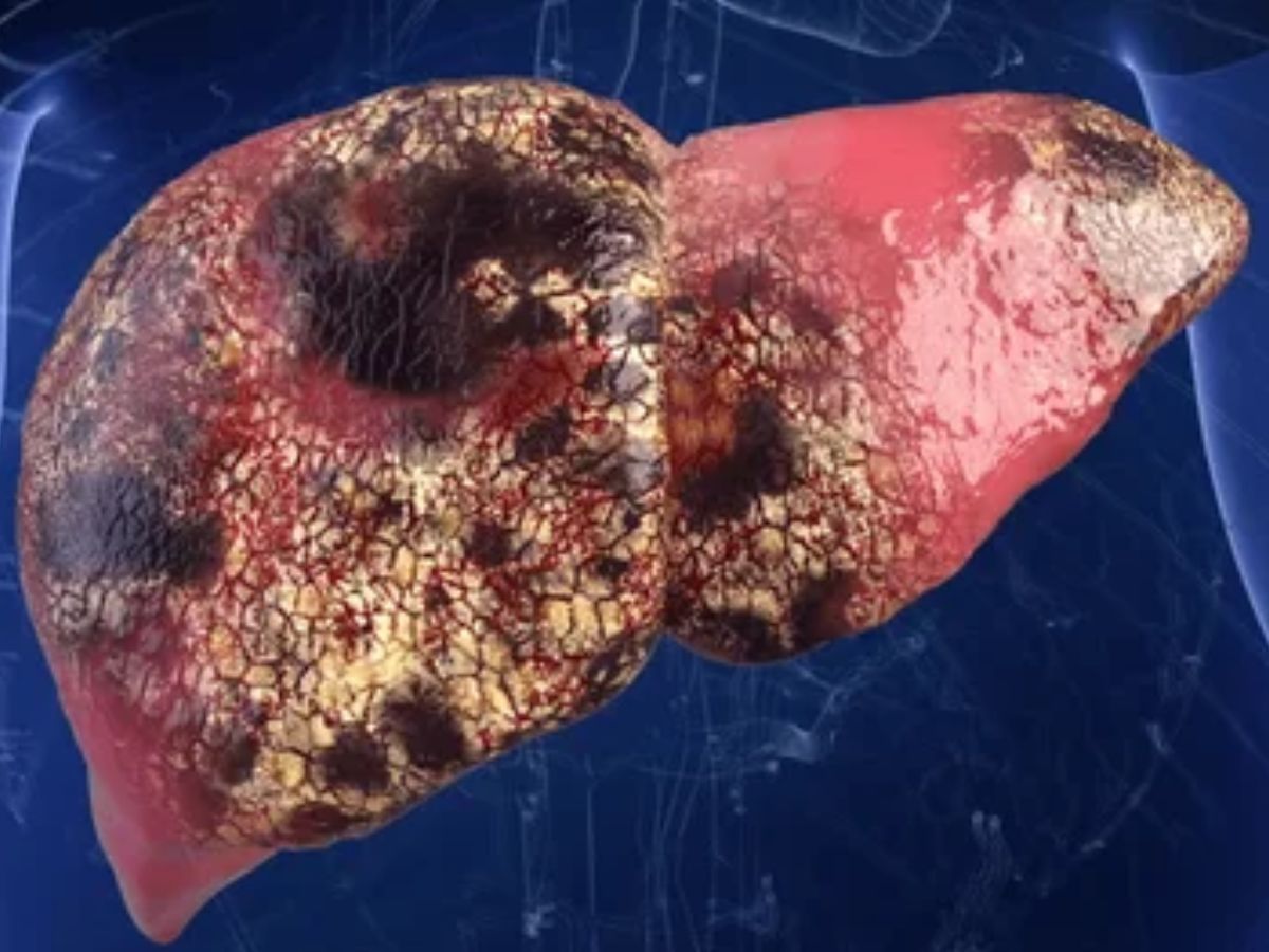Liver Failure Color dark yellow to red color stool can be indicate liver problems such as ...