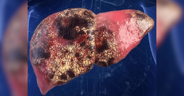 dark yellow to red color stool can be indicate liver problems such as