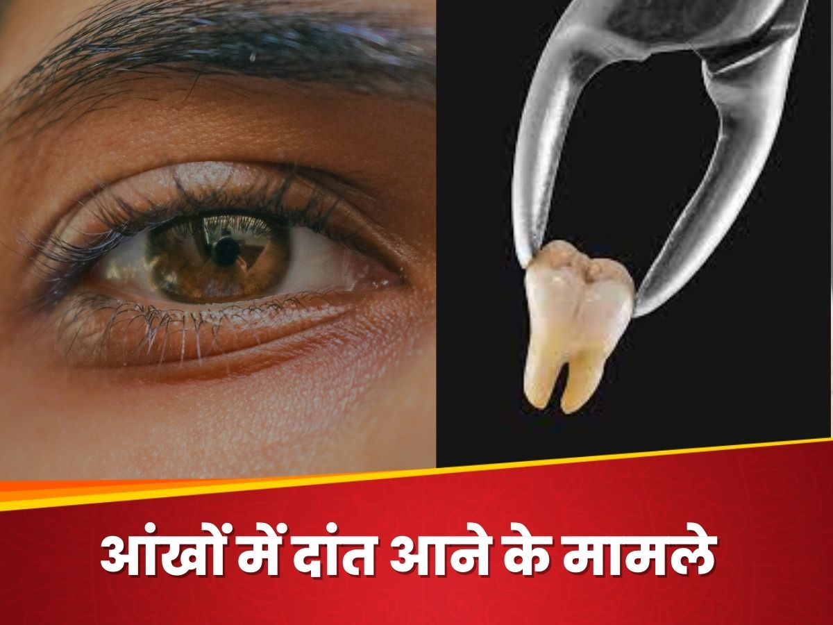 Tooth In Eye How Tooth Found in Eye Rare Medical Case In India Patna Bihar IGIMS ...