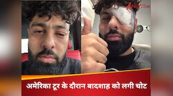 आंखों पर पट्टी चेहरे पर सूजन, कैसे लगी बादशाह को चोट? शेयर किया पोस्ट