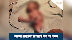 छत्तीसगढ़ में 'मरमेड बेबी' का जन्म, दोनों पैर जलपरी जैसे जुड़े हुए थे, हुई मौत