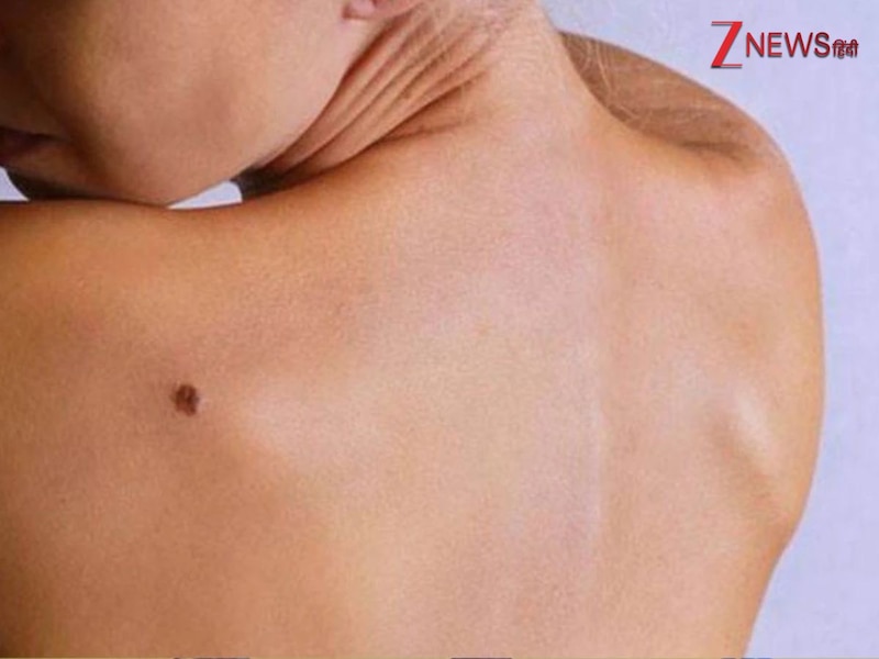 पीठ पर तिल 