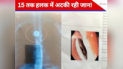 15 साल से तक हलक में अटका रहा सिक्का, फिर डॉक्टर्स ने किया ऐसा चमत्कार कि...
