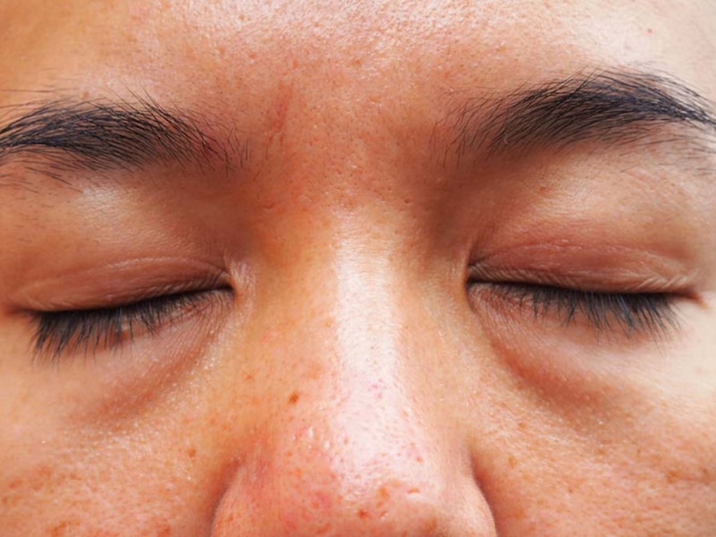 चेहरे पर सूजन 