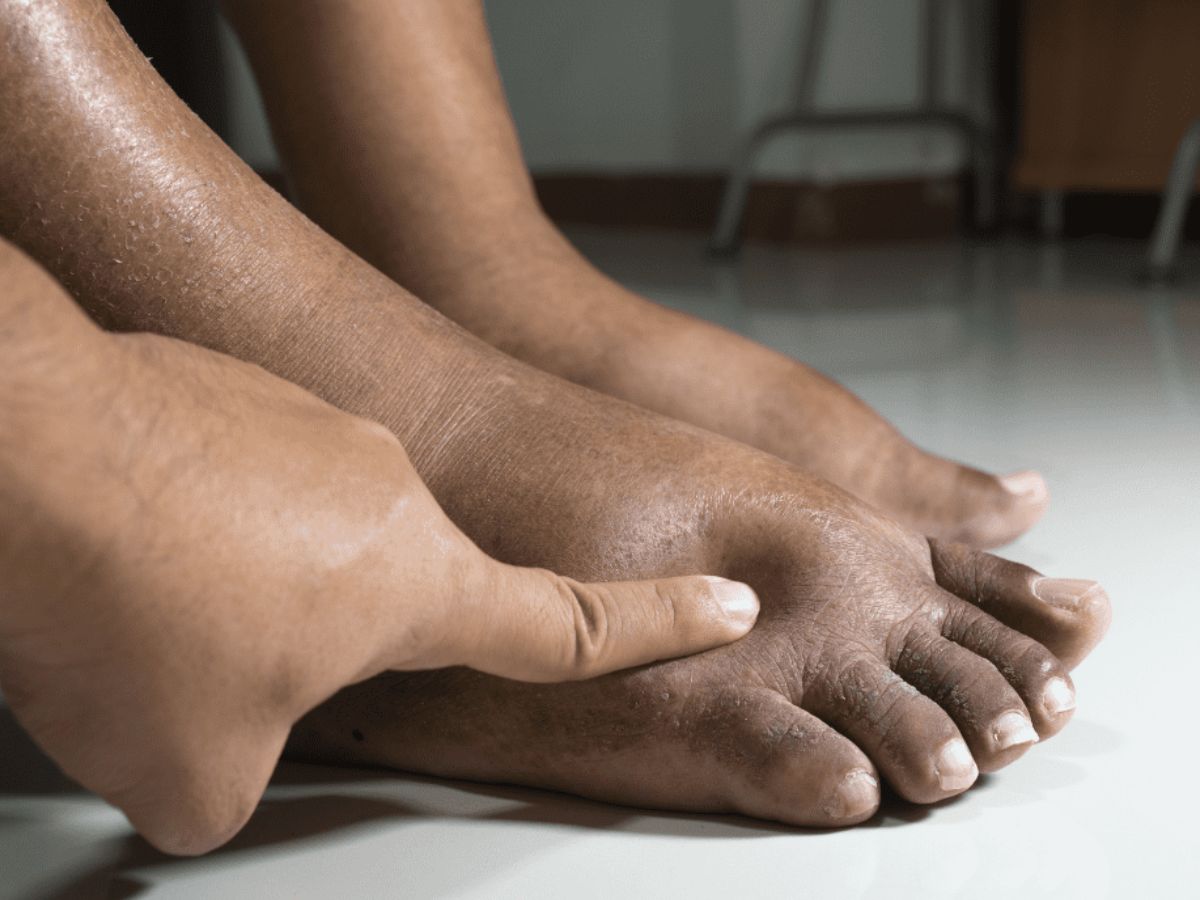 पैरों में सूजन