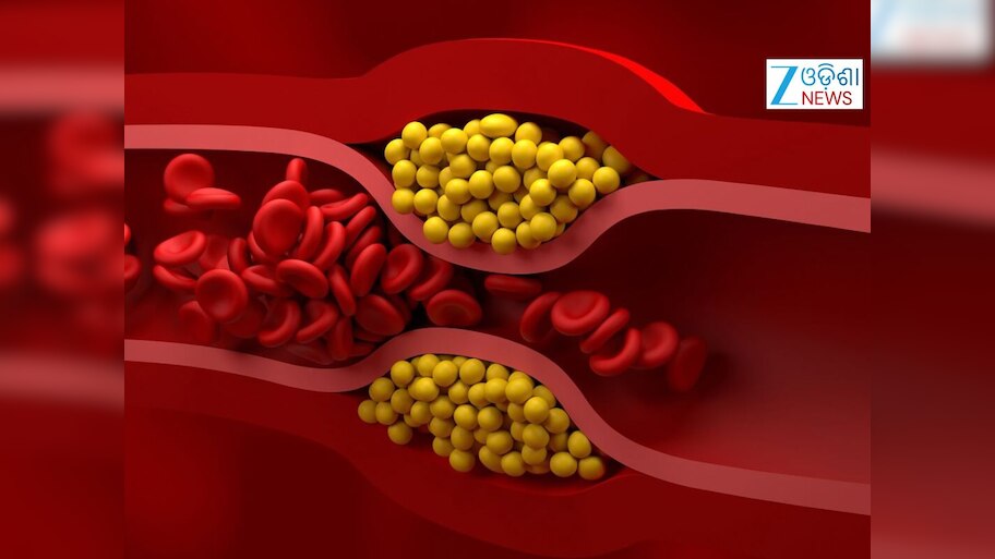 Bad Cholesterol: ଆମେରିକୀୟ ହୃଦରୋଗ ବିଶେଷଜ୍ଞ କହିଲେ ବଡ କଥା
