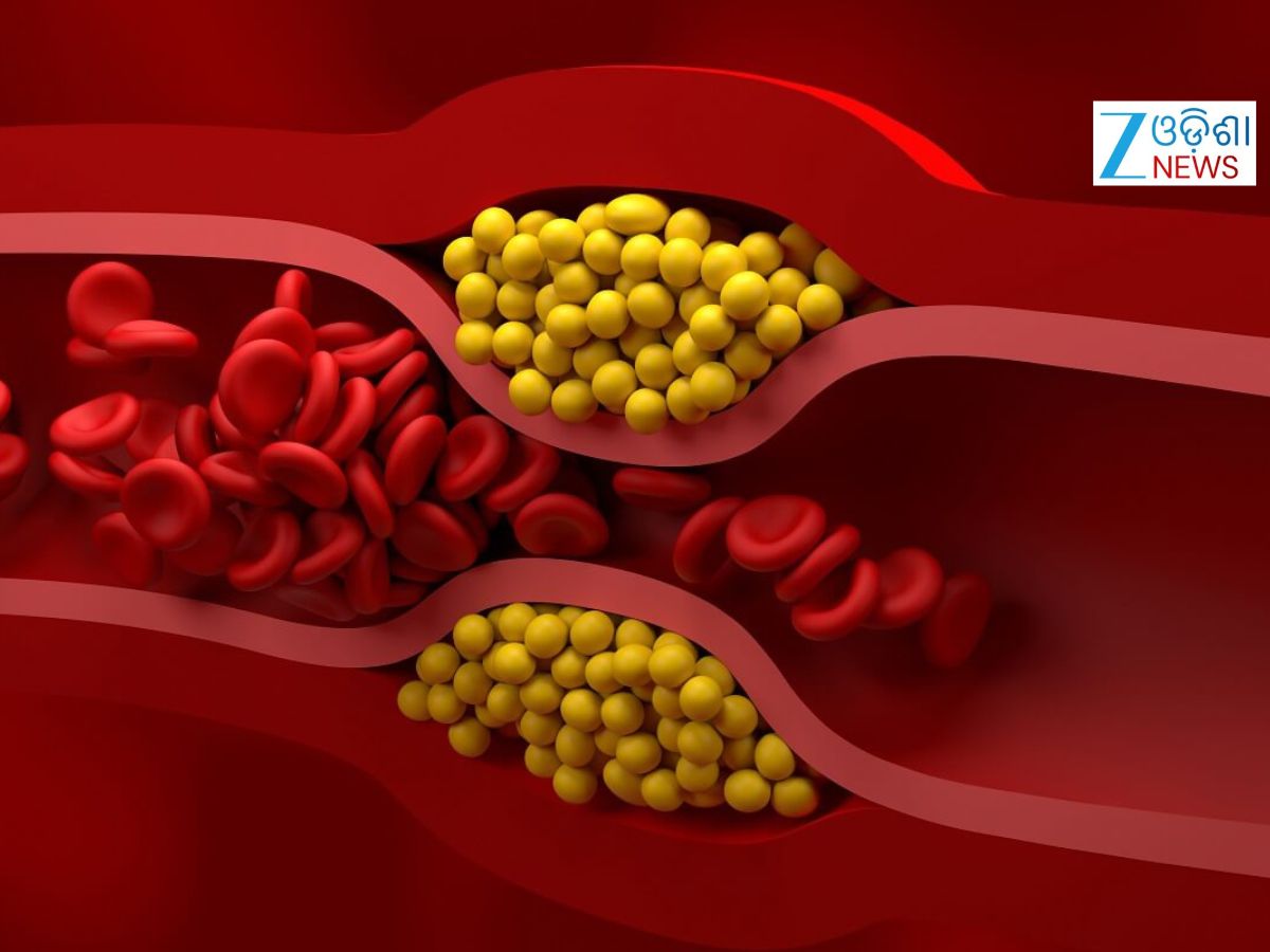 Bad Cholesterol: ଆମେରିକୀୟ ହୃଦରୋଗ ବିଶେଷଜ୍ଞ କହିଲେ ବଡ କଥା Bad Cholesterol: ଆମେରିକୀୟ ହୃଦରୋଗ ବିଶେଷଜ୍ଞ କହିଲେ ବଡ କଥା