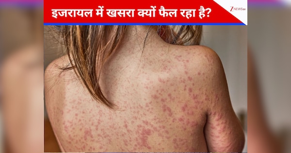 11 बच्चे मरे, 1644 संक्रमित, इजरायल में फिर 'दबे पांव' लौट आया खसरा! आखिर क्यों आई ये आफत