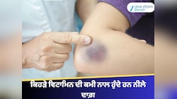 Vitamin Deficiency: ਸਿਹਤ ਲਈ ਖਤਰੇ ਦੀ ਘੰਟੀ ਹਨ ਕਾਲੇ-ਨੀਲੇ ਦਾਗ਼? 