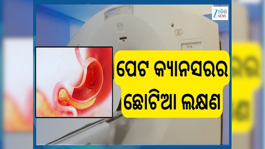 Stomach Cancer: ମଳରେ ରକ୍ତ ପଡ଼ୁଥିଲେ ସାବଧାନ ! ଅର୍ଶ କି ମଳକଣ୍ଟକ ନୁହେଁ ପେଟ କ୍ୟାନସର ହୋଇପାରେ କାରଣ