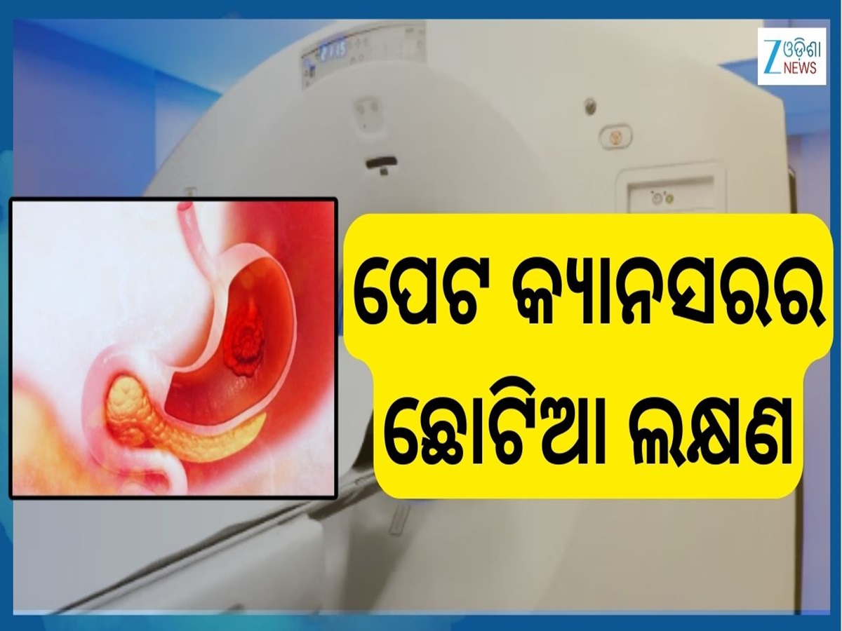 Stomach Cancer: ମଳରେ ରକ୍ତ ପଡ଼ୁଥିଲେ ସାବଧାନ ! ଅର୍ଶ କି ମଳକଣ୍ଟକ ନୁହେଁ ପେଟ କ୍ୟାନସର ହୋଇପାରେ କାରଣ Stomach Cancer: ମଳରେ ରକ୍ତ ପଡ଼ୁଥିଲେ ସାବଧାନ ! ଅର୍ଶ କି ମଳକଣ୍ଟକ ନୁହେଁ ପେଟ କ୍ୟାନସର ହୋଇପାରେ କାରଣ