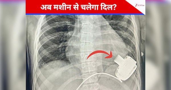 मौत के मुंह से लौटा 14 साल का दिलशाद...बच्चे के शरीर में लगा \'मैकेनिकल हार्ट\', भारत में पहली बार