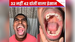इस शख्स के मुंह में निकले 32 नहीं बल्कि 42 दांत, एक्स-रे रिपोर्ट देख डॉक्टर भी हैरान