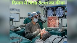 स्नैक वाइन पीती थी महिला, कमर दर्द की जांच हुई तो दिमाग में रेंगता मिला जिंदा कीड़ा!