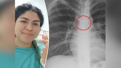 खांसी की दवा लेने गई थी महिला, X-Ray करवाया तो फेंफड़े में दिखी खोई हुई नोज रिंग!