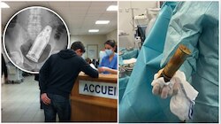 दर्द लेकर अस्पताल पहुंचा युवक, X-Ray देखते ही उड़े डॉक्टरों के होश... शरीर में मिला