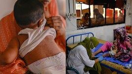 बांग्लादेश: खसरे का कहर जारी, 24 घंटे में 4 बच्चों की मौत; 844 लोगों की मौत