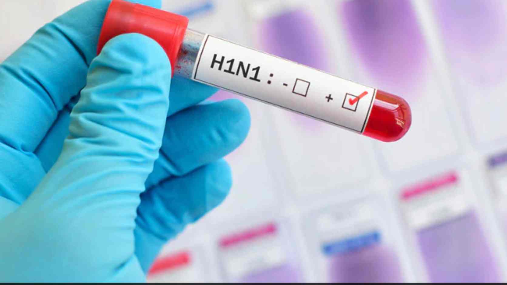 बिलासपुर में H1N1 के 7 मरीज मिले, 5 स्वस्थ होकर घर लौटे, 2 का इलाज जारी, स्वास्थ्य विभाग ने बढ़ाई निगरानी