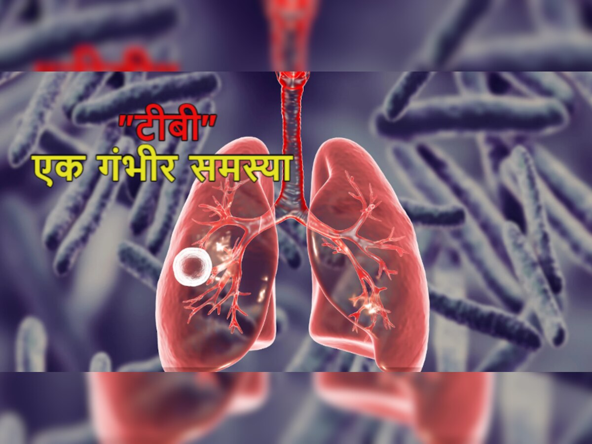 TB Disease: भारत में वर्षों से क्यों बनी है टीबी की गंभीर समस्या? जानें कैसे करना है खुद का बचाव 
