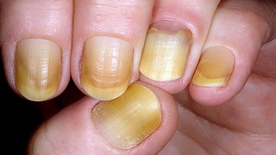 Yellow Nails: Symptoms, Causes, and Treatment