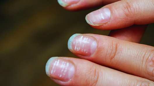 deficiency of vitamin B12 puts these harmful effects on nails