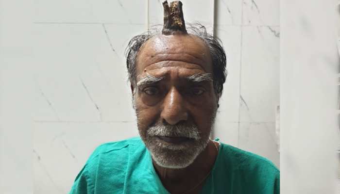 OMG! जब इंसान के सिर पर निकल आया 'सींग', मामला देख डॉक्टर भी रह गए हैरान OMG! जब इंसान के सिर पर निकल आया 'सींग', मामला देख डॉक्टर भी रह गए हैरान