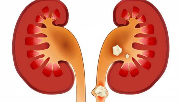 kidney stone add these food items in diet | असहनीय दर्द देता है किडनी स्टोन,  छुटाकारा पाने के लिए डाइट में शामिल करें ये खाद्य पदार्थ | Hindi News, सेहत