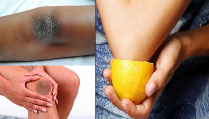 home remedies to brighten elbow and knees skin |Beauty Tips: कोहनी और घुटने  के कालेपन से हैं परेशान? अपनाएं ये 5 असरदार घरेलू नुस्खे | Hindi News,  लाइफस्टाइल