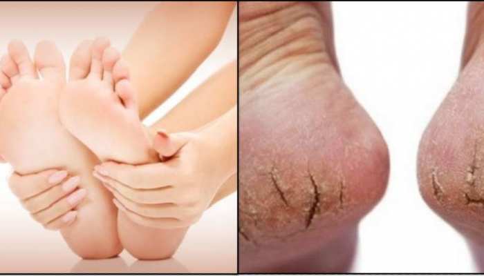 Home Remedies For Cracked Heels And Beautiful Legs