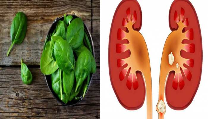 Kidney Stone की समस्या है तो ये चीजें भूल से भी न खाएं Kidney Stone की समस्या है तो ये चीजें भूल से भी न खाएं