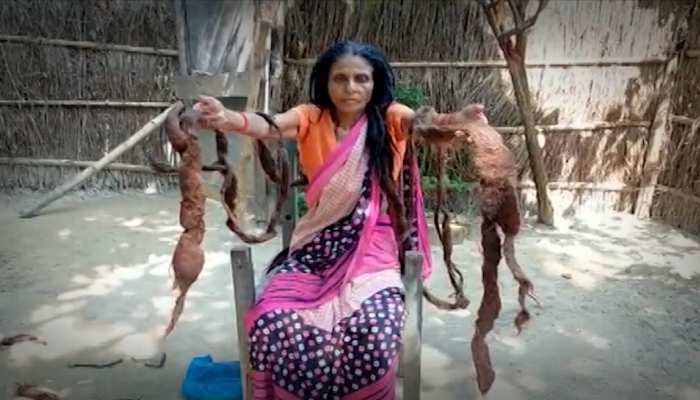 बिहार के बगहा में महिला ने लगाई सरकार से गुहार, कहा- बढ़ते बालों का कराइए इलाज बिहार के बगहा में महिला ने लगाई सरकार से गुहार, कहा- बढ़ते बालों का कराइए इलाज