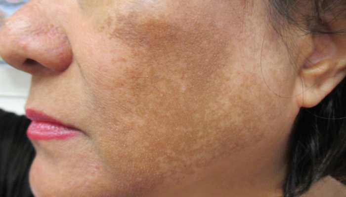 dark spots treatment ginger to remove dark spots at home janiye daag dhabbe  hatane kaise hatae samp | Beauty Tips: अदरक के टुकड़े के साथ मिलाएं ये चीज,  एक्ट्रेस जैसा बेदाग हो
