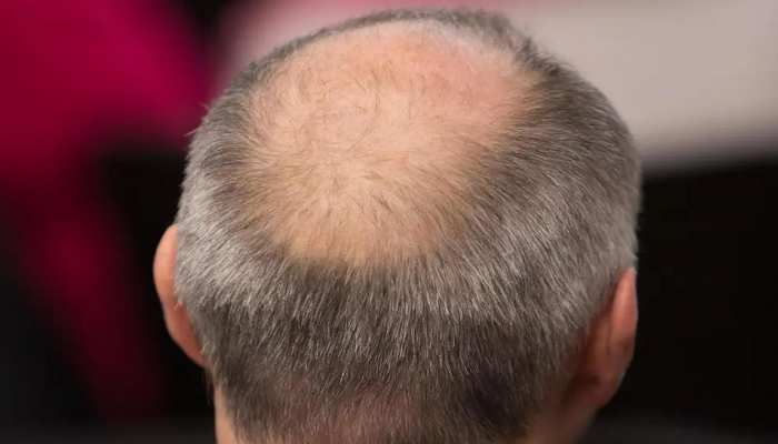 yoga for hair do balayam yoga to prevent baldness know benefits and steps samp | Yoga for hair : रोज 5 मिनट ये योग करने से कभी नहीं होंगे गंजे, लंबे और yoga for hair do balayam yoga to prevent baldness know benefits and steps samp | Yoga for hair : रोज 5 मिनट ये योग करने से कभी नहीं होंगे गंजे, लंबे और