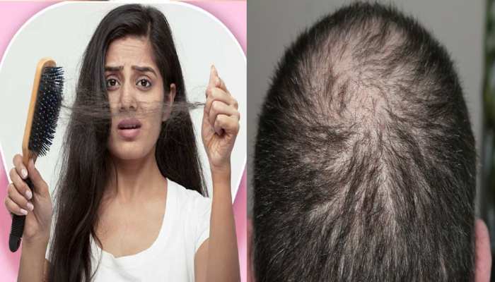 Reason of hair loss These are the 5 reasons due to which your hair starts falling brmp | Reason of hair loss: ये हैं वो 5 कारण जिनकी वजह से झड़ने लगते Reason of hair loss These are the 5 reasons due to which your hair starts falling brmp | Reason of hair loss: ये हैं वो 5 कारण जिनकी वजह से झड़ने लगते