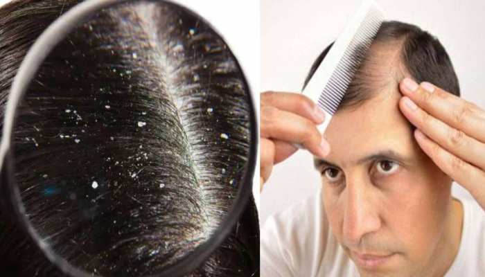 dont do these mistakes while hair care in winters that cause dandruff and hair  fall problem samp | Dandruff and Hair fall: ठंड में ये गलती करने से सिर में  भर जाएगा