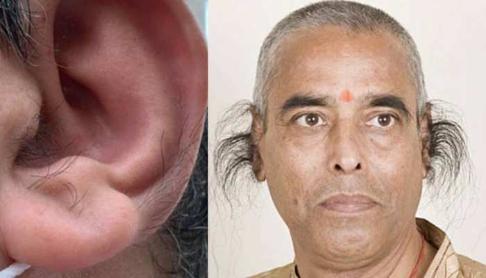 Ear hair removal before and after  Allure Spa and Salon