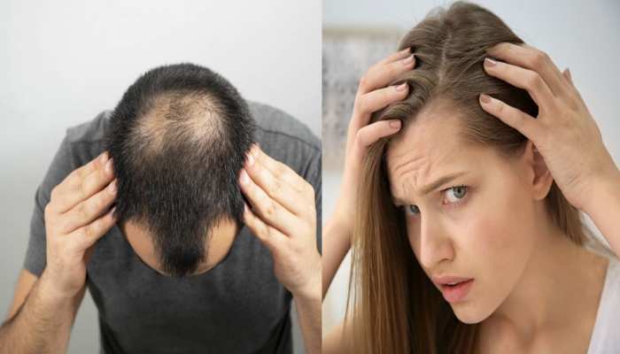 hair loss treatment five major causes of hair loss Home Remedies For Hair Loss brmp | Hair loss: ये हैं वो 5 कारण जिनकी वजह से झड़ने लगते हैं बाल, इन 2 hair loss treatment five major causes of hair loss Home Remedies For Hair Loss brmp | Hair loss: ये हैं वो 5 कारण जिनकी वजह से झड़ने लगते हैं बाल, इन 2