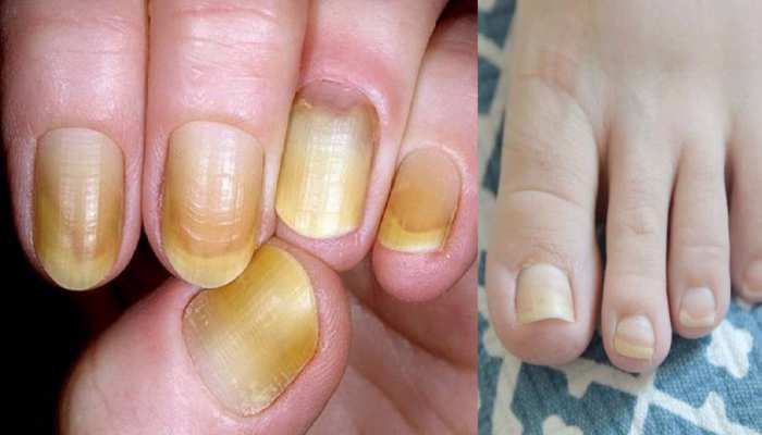 home remedy to remove yellowness from nails know how to get white and glowing nails samp | Tips for White Nails: घर पर ही दूर कर सकते हैं नाखूनों का पीलापन, लगेंगे home remedy to remove yellowness from nails know how to get white and glowing nails samp | Tips for White Nails: घर पर ही दूर कर सकते हैं नाखूनों का पीलापन, लगेंगे