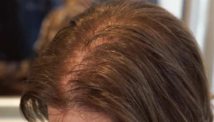 Hair Loss Problem of Hair Loss Best hair mask for hair treatment for hair  fall BRMP | Hair Loss: अगर आपके बाल भी झड़ रहे हैं तो लगाएं ये चीज, हेयर हो