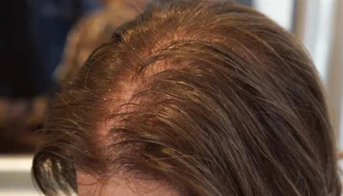 Hair Loss Problem of Hair Loss Best hair mask for hair treatment for hair fall BRMP | Hair Loss: अगर आपके बाल भी झड़ रहे हैं तो लगाएं ये चीज, हेयर हो Hair Loss Problem of Hair Loss Best hair mask for hair treatment for hair fall BRMP | Hair Loss: अगर आपके बाल भी झड़ रहे हैं तो लगाएं ये चीज, हेयर हो